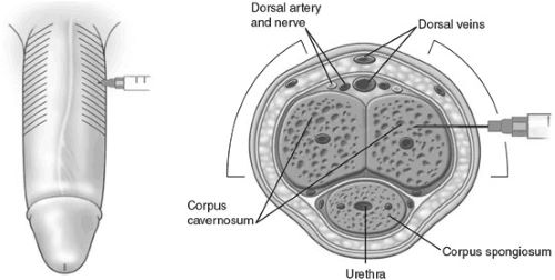 penile injection001